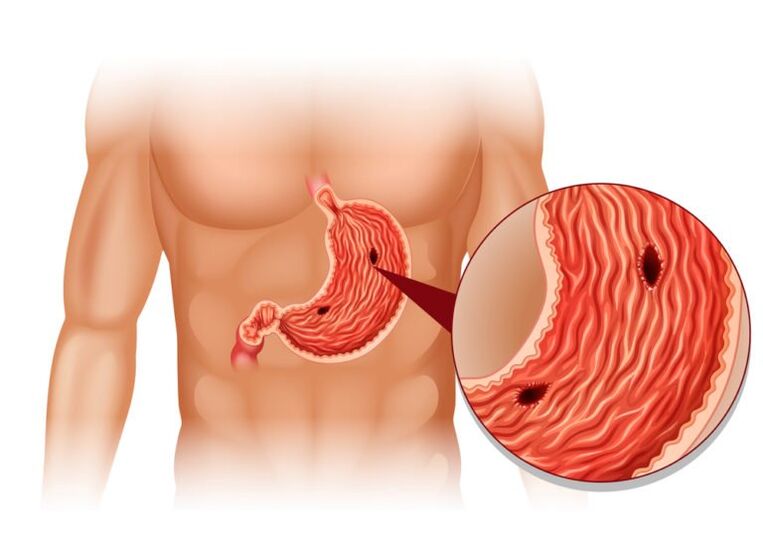 Las úlceras son la causa del dolor debajo del omóplato izquierdo. 