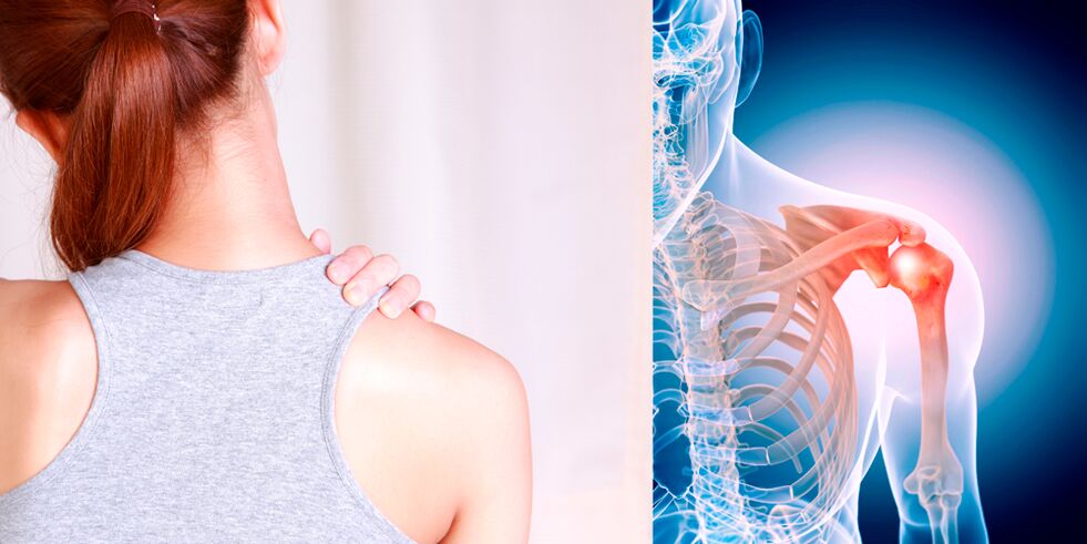 El desarrollo de la osteoartritis del hombro conduce gradualmente a un dolor persistente. 