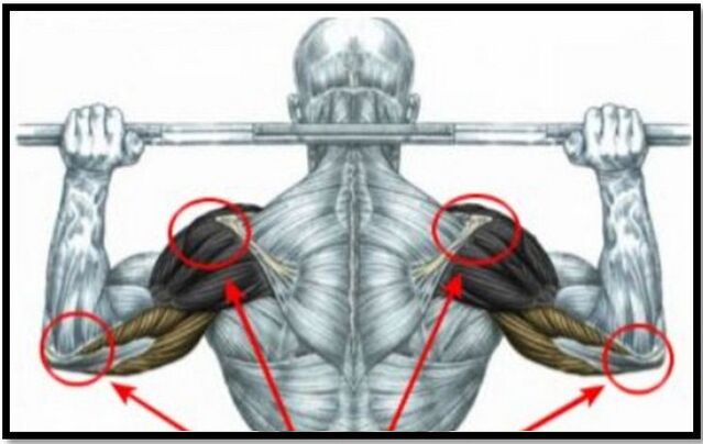 La carga de los músculos del hombro y del codo es una de las causas de la artritis del hombro. 