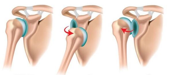 Luxación anterior y posterior de la articulación del hombro, que causa artrosis. 