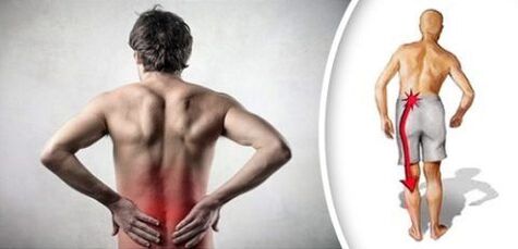 Síndrome de dolor con condrosis lumbar se irradia en las piernas