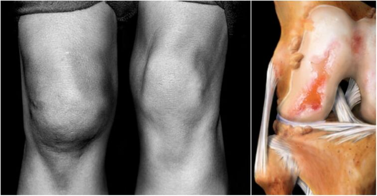 Articulaciones de rodilla y dolores de articulación