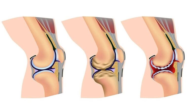 La etapa de deformación de la rodilla de la articulación