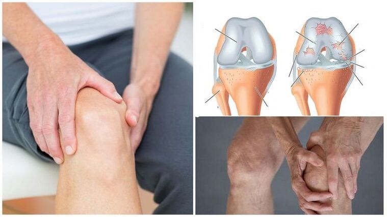 Síntomas del dolor de rodilla en las articulaciones