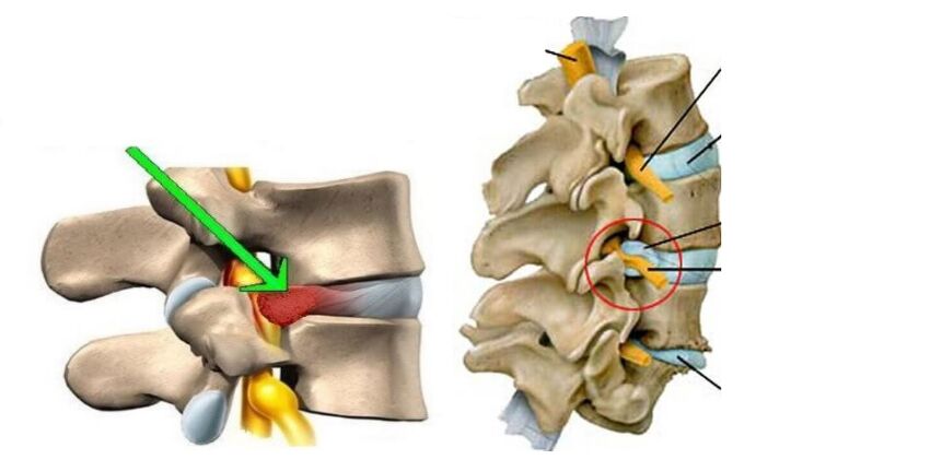 Dolor lumbar causado por una hernia de disco.