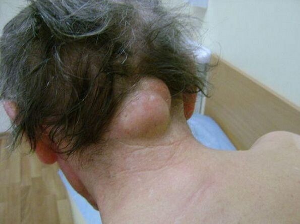 Hinchazón en el cuello que causa dolor.