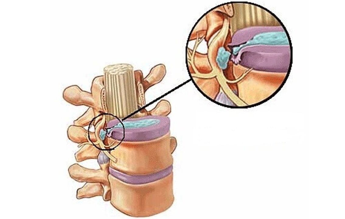Hernia intervertebral combinada con osteocondrosis torácica.