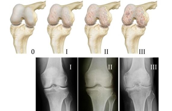 Métodos de diagnóstico para la artropatía de rodilla