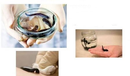 Terapia de sanguijuelas para enfermedades de las articulaciones.