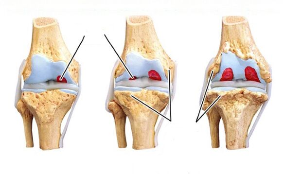 Varias etapas de la enfermedad de la articulación de la rodilla.