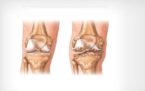 artritis de rodilla